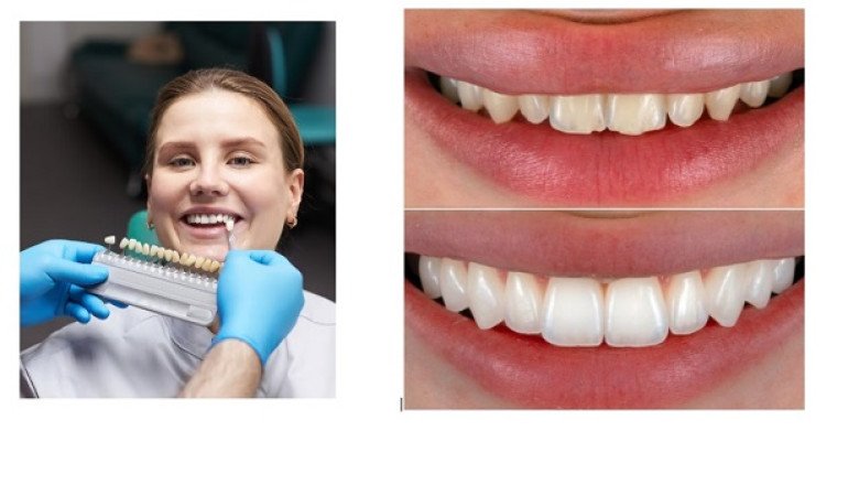 11 Best Clinics to Get Natural-Looking Veneers in Dubai (2025 Edition)